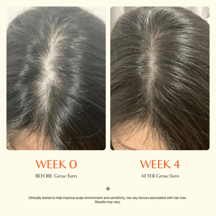 Imagem aproximada do couro cabeludo antes e depois de 4 semanas – risca do cabelo mais definida, com aspeto mais denso após o tratamento.