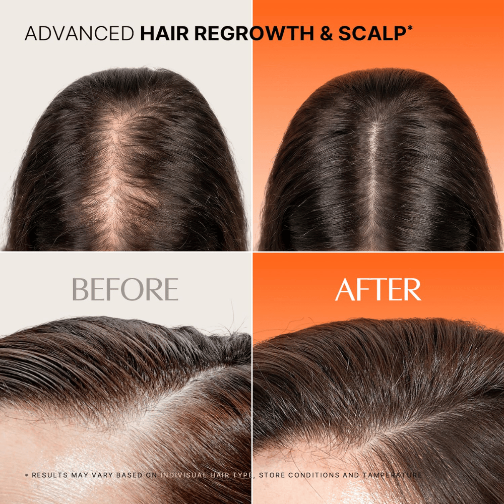Imagem de antes e depois do cabelo e do couro cabeludo com a utilização de LILYEVE Grow Turn Exosome Spicule Ampoule 3000.