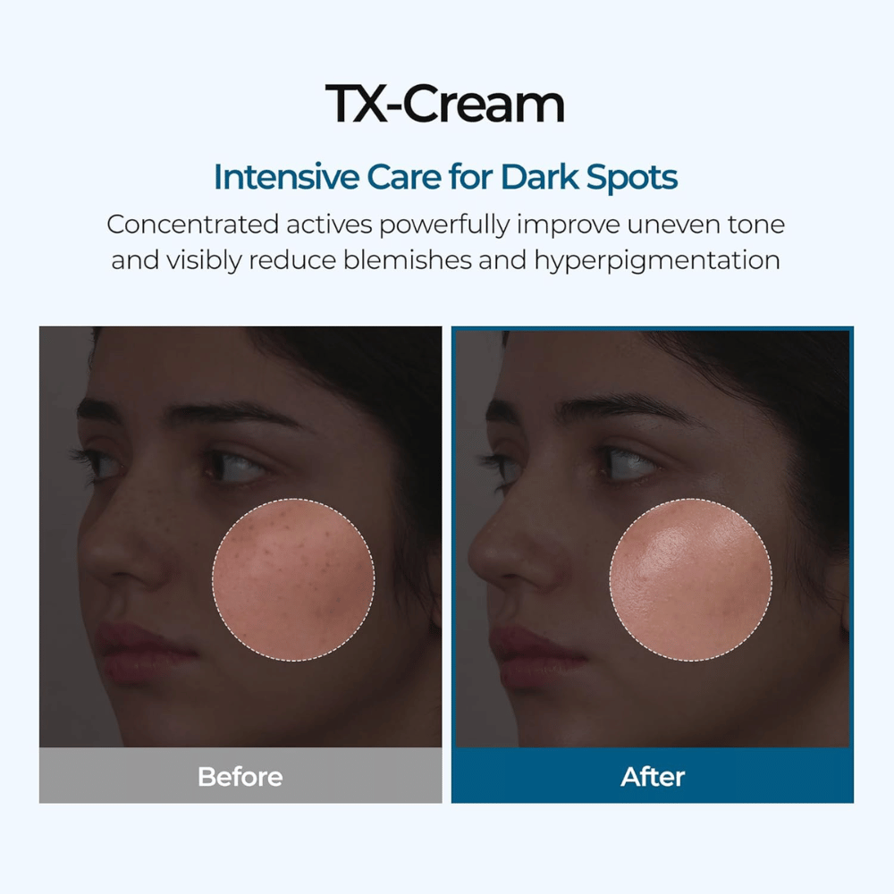 Resultados antes e depois com TX Cream que reduz manchas escuras e o tom de pele irregular para uma pele visivelmente mais clara e uniforme
