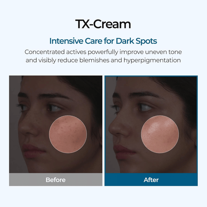 Resultados antes e depois com TX Cream que reduz manchas escuras e o tom de pele irregular para uma pele visivelmente mais clara e uniforme